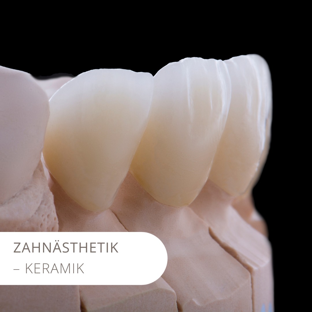 Größere Zahndefekte versorgen wir erfolgreich mit Keramikrestaurationen (Inlays, Teilkronen, Kronen und Veneers). Diese sind kaum anfällig für Verfärbungen und insbesondere im Seitenzahnbereich aufgrund ihrer Langlebigkeit zu empfehlen. Optisch schöne wie gesunde Zähne durch die ästhetische Zahnheilkunde im Zahnwerk Frankfurt. Getreu dem Motto: Wie Du siehst, siehst Du nichts. #zahnarzt #smile #zahnheilkunde #ästhetischezahnheilkunde #ästhetik #zahnwerk #bleaching #veneers #frankfurt #keramik #zahnmedizin #medizin #leidenschaft #zahngesundheit #mundgesundheit